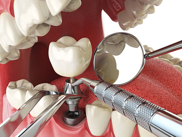 Best Knocked-Out Tooth (Avulsed Tooth) Treatment in Glasgow Village, MO